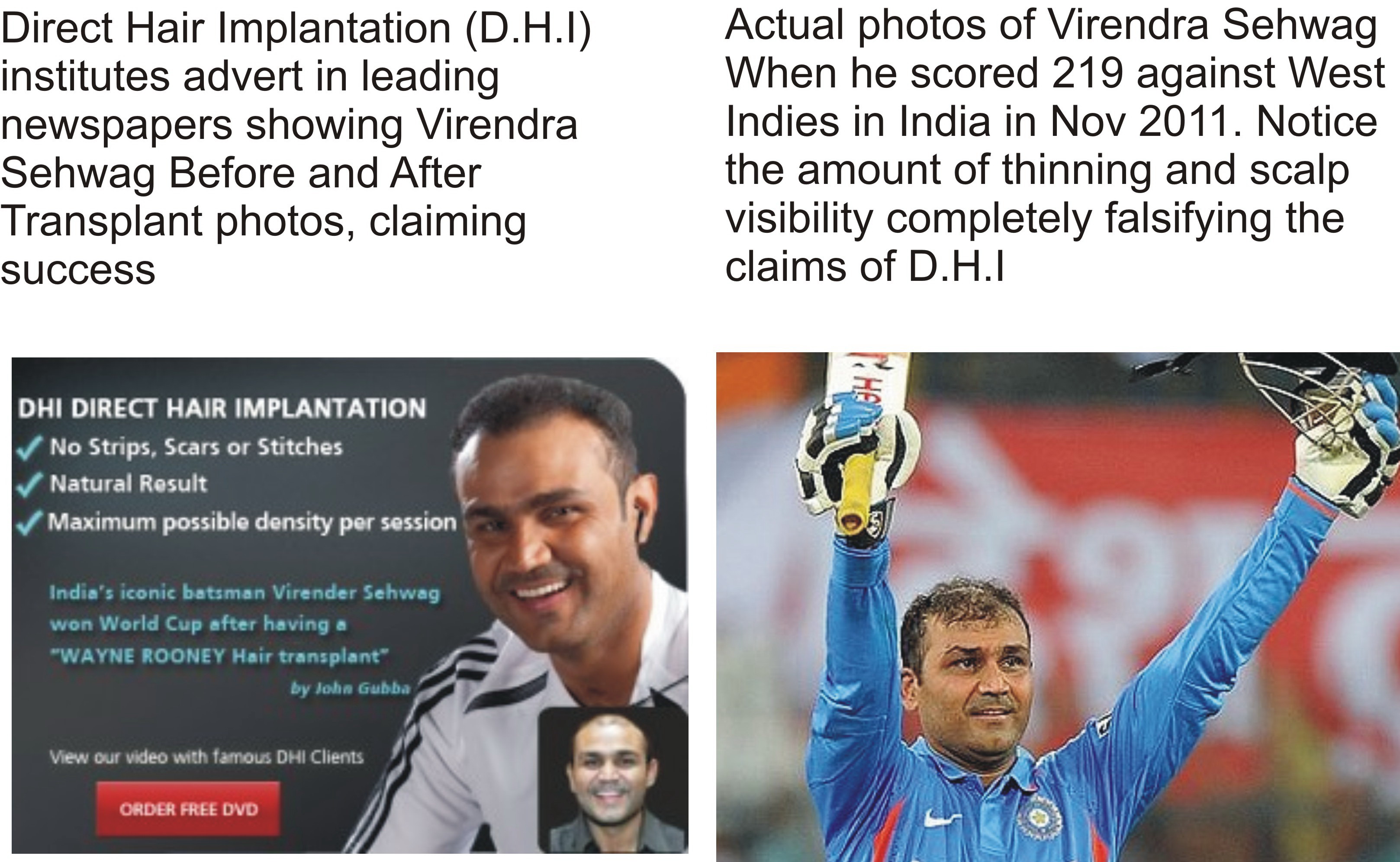 Hair Transplant Is A Scam Dhi Hair Transplant Clinic Bangalore