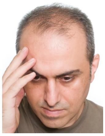 Causes Natural Remedies For Hair Fall Hair And Skin Care
