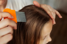 Getting Rid of Dandruff and Lice