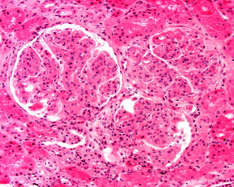 Poststreptococcal glomerulonephritis, a complicate whatissorethroat